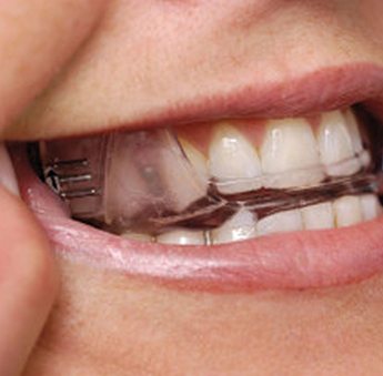 Closeup of teeth with oral appliance in place