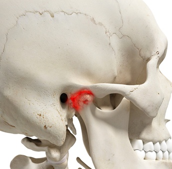 A digital image of a skeleton and the temporomandibular joint showing red for being inflamed