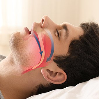 Sleeping man with airway animation on his profile
