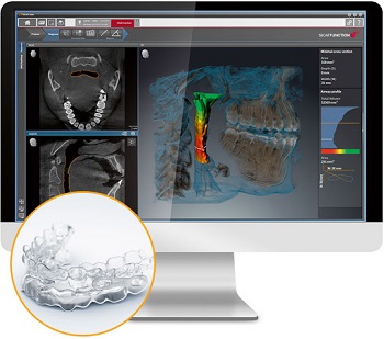 The X-Ray image captured with the Sirona Orthophos CBCT Airway Imaging device