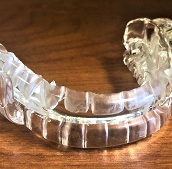 An example of an oral device used to treat obstructive sleep apnea