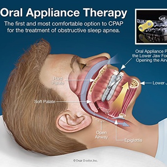 A drawing of a patient lying down and a cross-section of their mouth and how an oral appliance is helping to open their airway and improve their breathing