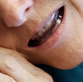 Closeup of patient with sleep apnea appliance in place