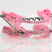 Somnodent SUAD oral appliance