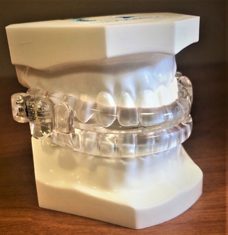 a sleep apnea oral appliance 